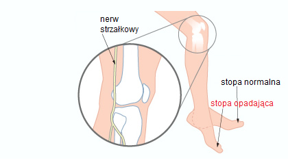 Ilustracja prezentująca różnicę między stopą normalną, a opadającą